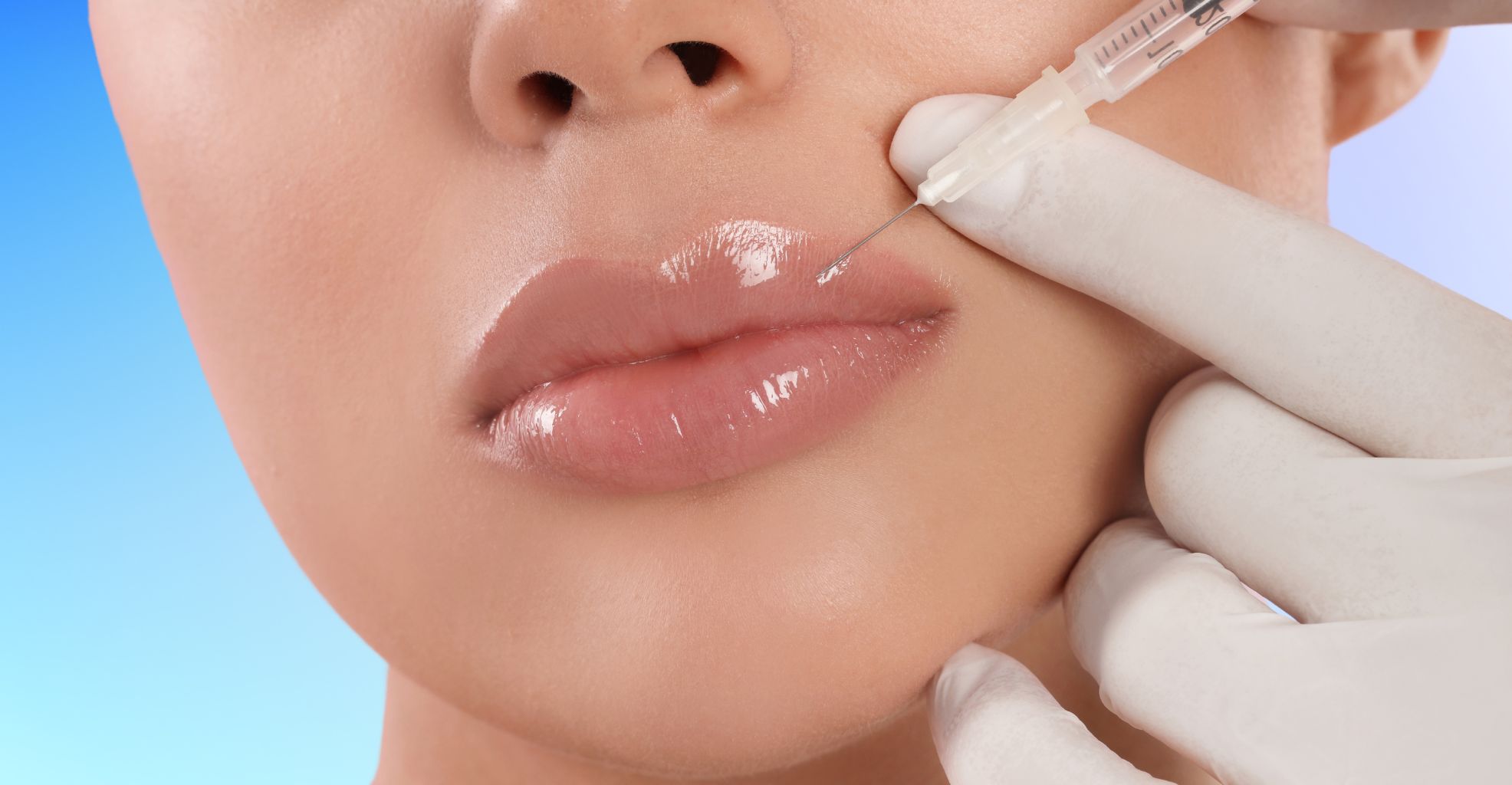 Filler per labbra rughe nasogeniene e ruga della marionetta Filler per labbra rughe nasogeniene e ruga della marionetta