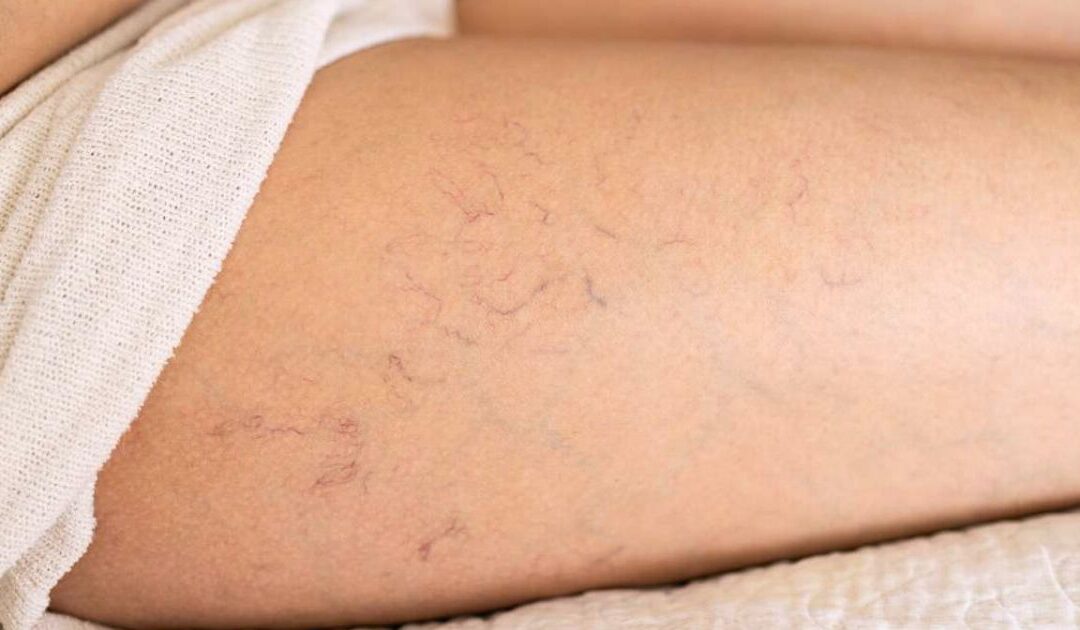 Radio Frequenza Skin Therapy per le spider veins delle gambe