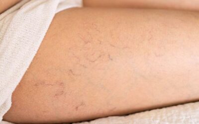 Radio Frequenza Skin Therapy per le spider veins delle gambe