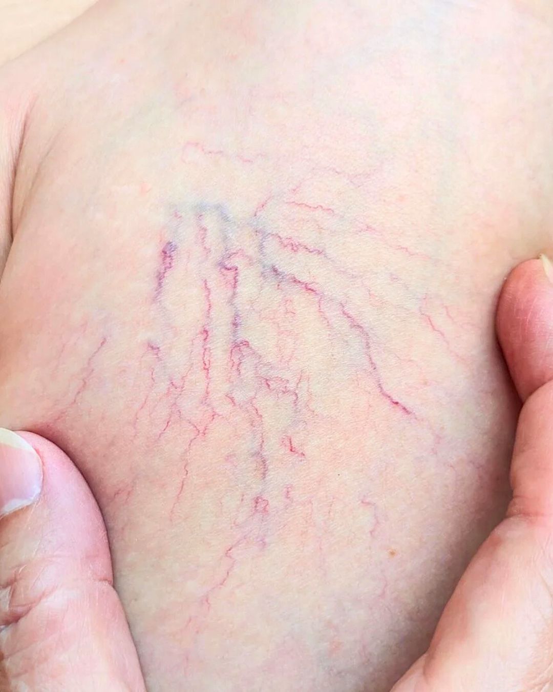 Radio Frequenza Skin Therapy per le vene a tela di ragno