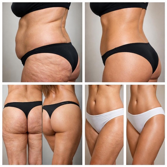 Pacchetto rimodellamento corpo